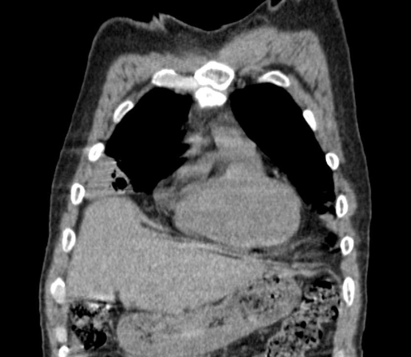 Airway foreign body in adult (Radiopaedia 85907-101779 Coronal liver window 46).jpg