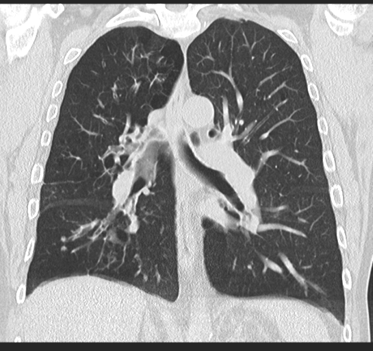Allergic bronchopulmonary aspergillosis (Radiopaedia 44760-48571 Coronal lung window 34).png