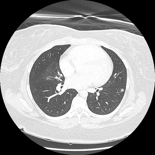 Alveolar soft part sarcoma - right leg (Radiopaedia 59432-67091 Axial lung window 61).jpg