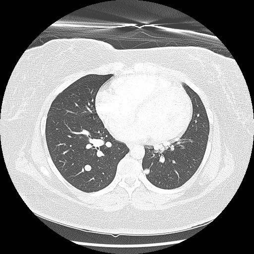 Alveolar soft part sarcoma - right leg (Radiopaedia 59432-67091 Axial lung window 69).jpg