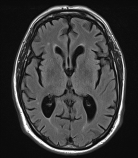 File:Alzheimer's disease- with Gerstmann syndrome and dressing apraxia (Radiopaedia 54882-61150 Axial FLAIR 14).png