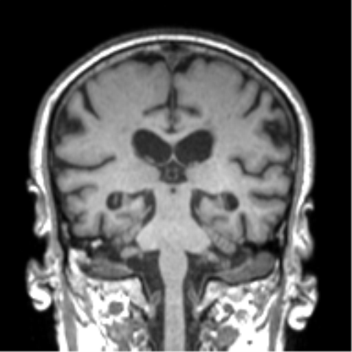 Alzheimer disease and cerebral amyloid angiopathy (Radiopaedia 64234-73011 Coronal T1 25).png