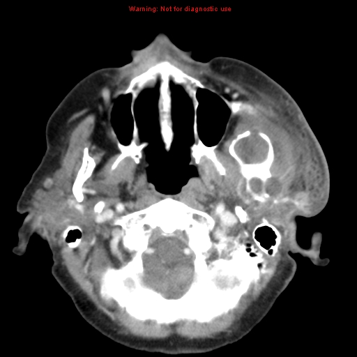 File:Ameloblastoma (Radiopaedia 27437-27631 A 22).jpg