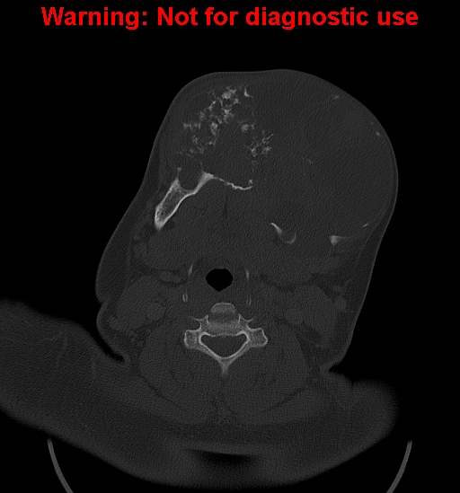 Ameloblastoma (Radiopaedia 33126-34164 Axial bone window 20).jpg