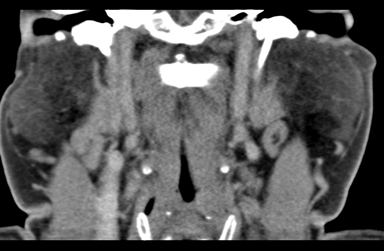 Ameloblastoma (Radiopaedia 33677-34806 Coronal non-contrast 43).png