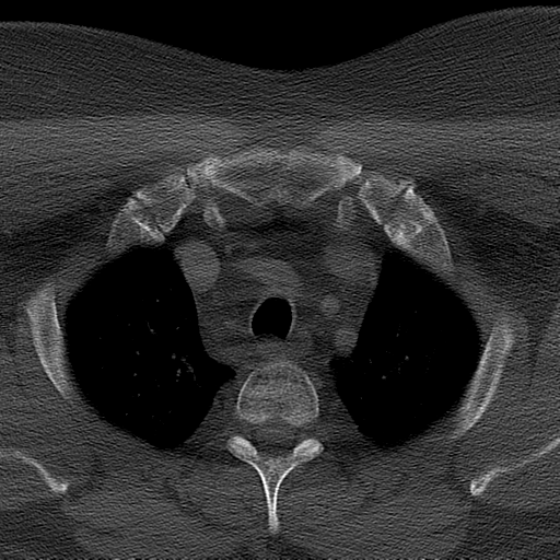 Ameloblastoma (Radiopaedia 38520-40623 Axial bone window 80).png