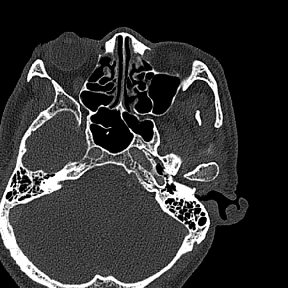 Ameloblastoma (Radiopaedia 51921-57766 Axial bone window 156).jpg