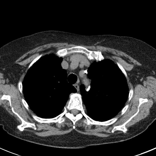File:Amiodarone-induced pulmonary fibrosis (Radiopaedia 82355-96460 Axial non-contrast 18).jpg