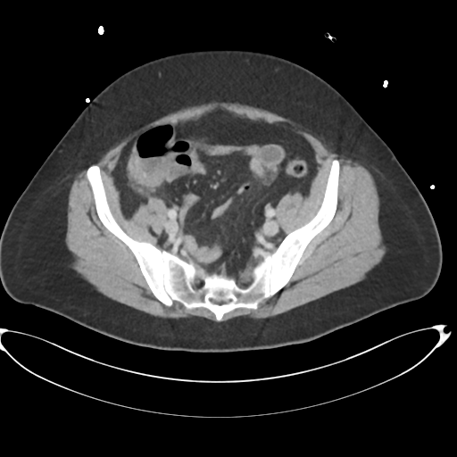 File:Amoebic liver abscess (Radiopaedia 52611-58530 A 77).png