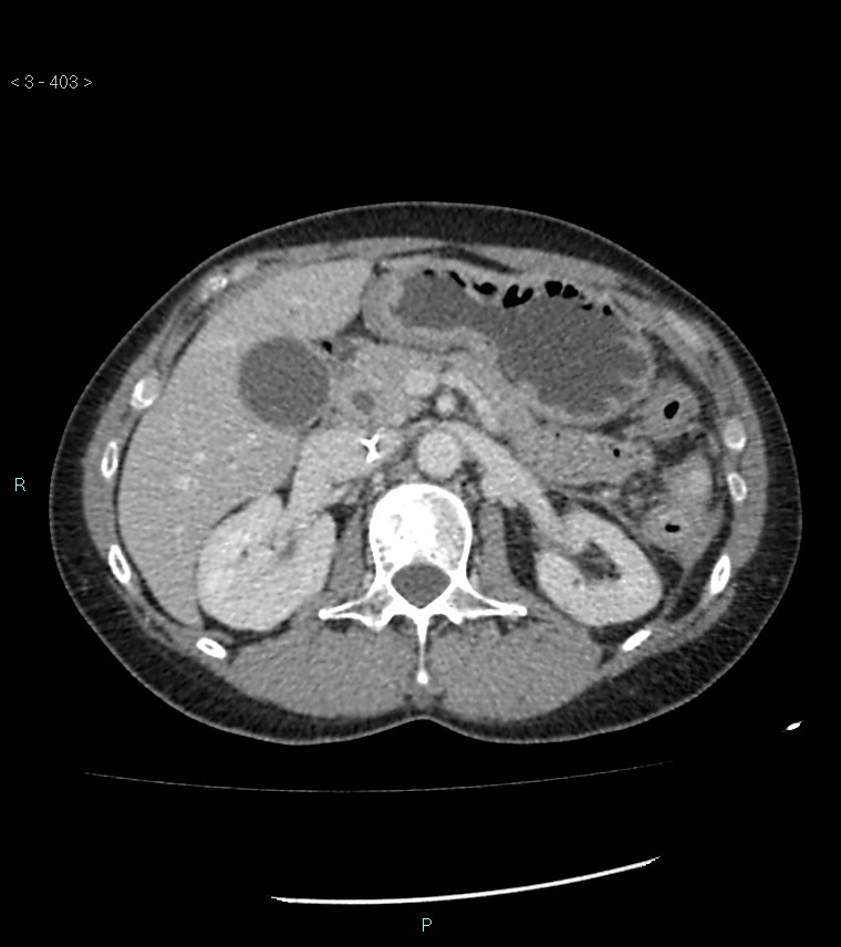 Ampulla of Vater metastasis (Radiopaedia 27820-28069 A 41).jpg