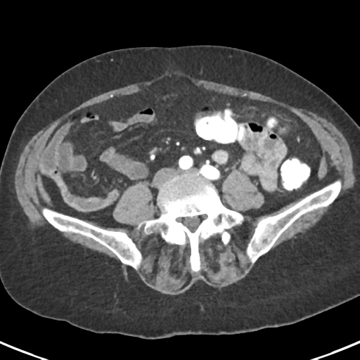 Ampullary adenocarcinoma (Radiopaedia 34013-35237 B 65).png