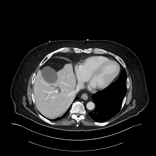 Ampullary adenocarcinoma (Radiopaedia 59373-66734 C 26).jpg