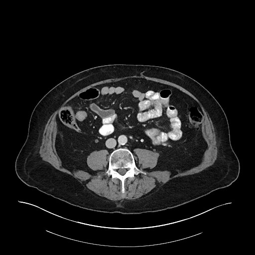 Ampullary adenocarcinoma (Radiopaedia 59373-66734 C 96).jpg
