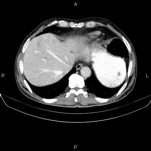 Ampullary adenocarcinoma (Radiopaedia 86093-102032 A 10).jpg