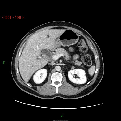 File:Ampullary carcinoma (Radiopaedia 56396-63056 C 33).jpg