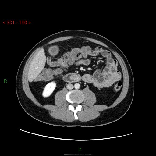 File:Ampullary carcinoma (Radiopaedia 56396-63056 C 54).jpg