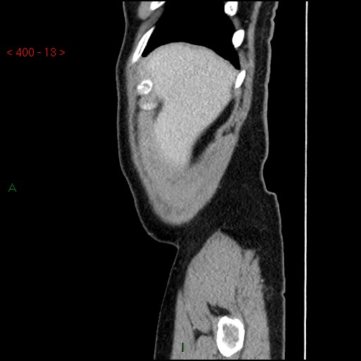 Ampullary carcinoma (Radiopaedia 56396-63056 D 12).jpg