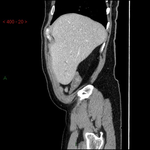 Ampullary carcinoma (Radiopaedia 56396-63056 D 19).jpg