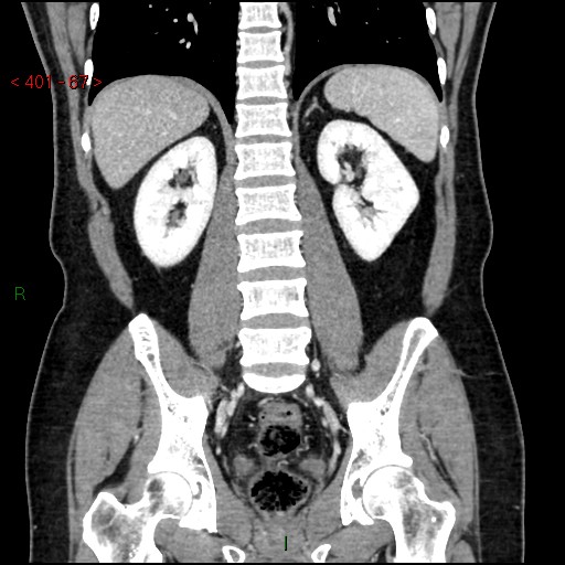 Ampullary carcinoma (Radiopaedia 56396-63056 E 66).jpg