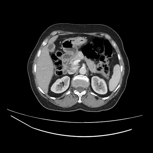 File:Ampullary tumor (Radiopaedia 60333-67998 A 24).jpg