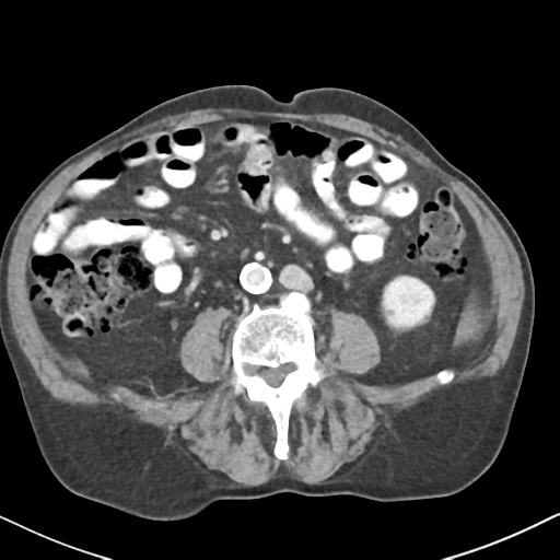 File:Amyand hernia (Radiopaedia 39300-41547 A 39).png