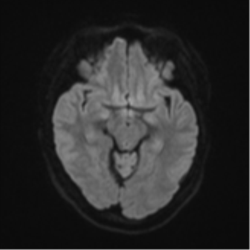 Anaplastic astroblastoma (Radiopaedia 55666-62194 Axial DWI 40).png
