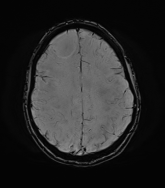 File:Anaplastic astrocytoma IDH mutant (Radiopaedia 50046-55341 Axial SWI 64).png