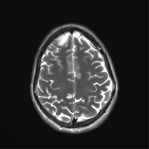 File:Anaplastic astrocytoma IDH mutant (Radiopaedia 50046-55341 Axial T2 30).png