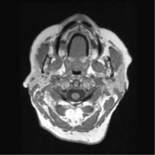 File:Anaplastic astrocytoma IDH wild-type (pseudoprogression) (Radiopaedia 42209-45276 Axial T1 7).png