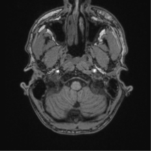 Anaplastic oligodendroglioma with skull fracture (Radiopaedia 74831-85845 Axial T1 1).png