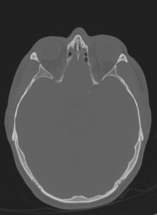 Anaplastic oligodendroglioma with skull fracture (Radiopaedia 74831-85846 Axial bone window 45).png