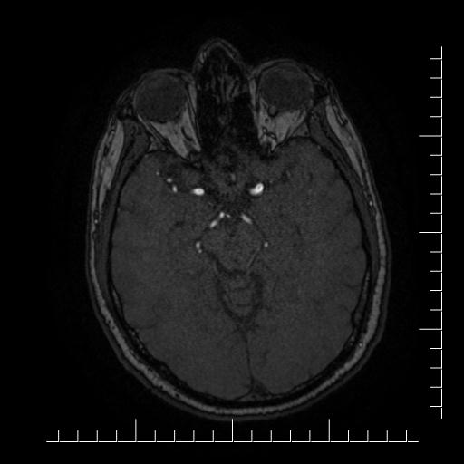 File:Aneurysm of posterior communicating artery (Radiopaedia 20188-20163 Axial MRA 26).jpg