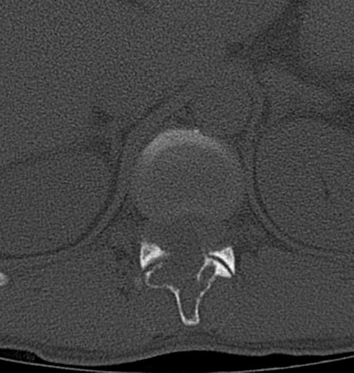 Aneurysmal bone cyst T11 (Radiopaedia 29294-29721 Axial bone window 48).jpg