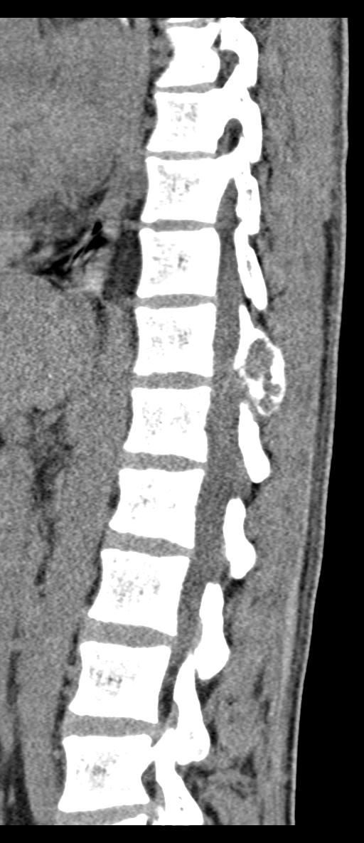Aneurysmal bone cyst T11 (Radiopaedia 29294-29721 E 35).jpg