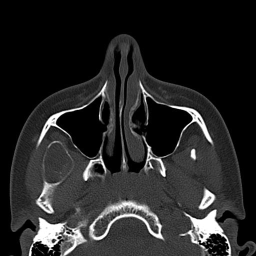 File:Aneurysmal bone cyst of the mandible (Radiopaedia 43280-46601 Axial bone window 69).jpg