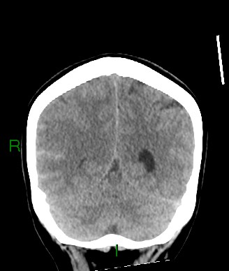 File:Aneurysmal subarachnoid hemorrhage with intra-axial extension (Radiopaedia 84371-99699 Coronal non-contrast 22).jpg