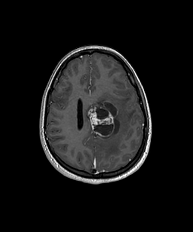 Angiomatous meningioma (Radiopaedia 79459-92577 Axial T1 C+ 3D ISO 27).jpg
