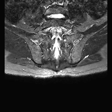 File:Ankylosing spondylitis with zygapophyseal arthritis (Radiopaedia 38433-40517 D 11).jpg