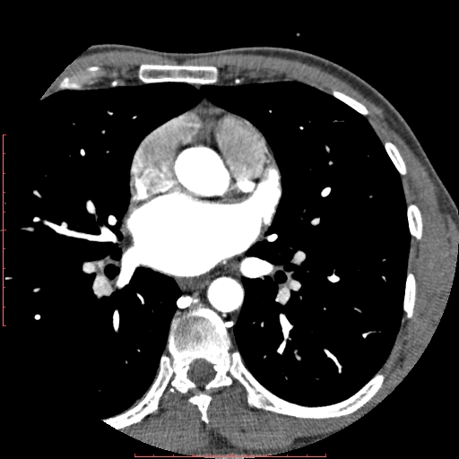 Anomalous left coronary artery from the pulmonary artery (ALCAPA) (Radiopaedia 70148-80181 A 100).jpg
