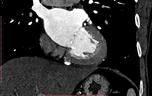 Anomalous left coronary artery from the pulmonary artery (ALCAPA) (Radiopaedia 70148-80181 B 173).jpg
