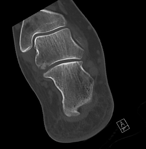 Anterior calcaneal process fracture (Radiopaedia 63353-71943 Axial bone window 105).jpg