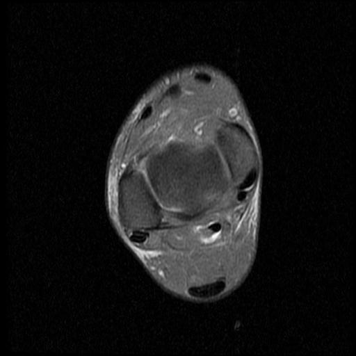 File:Anterior calcaneal process fracture (Radiopaedia 71377-81705 Axial PD fat sat 5).jpg