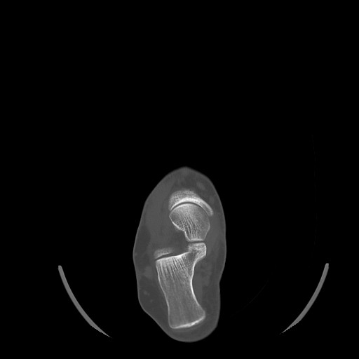 Anterior calcaneal process fracture (Radiopaedia 82590-96762 Axial bone window 20).jpg