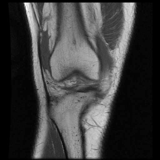 File:Anterior cruciate ligament avulsion fracture (Radiopaedia 58939-66193 Coronal T1 6).jpg