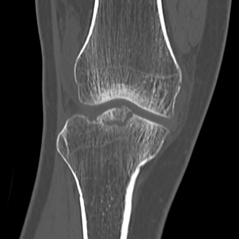 File:Anterior cruciate ligament avulsion fracture (Radiopaedia 58939-66194 Coronal bone window 9).jpg