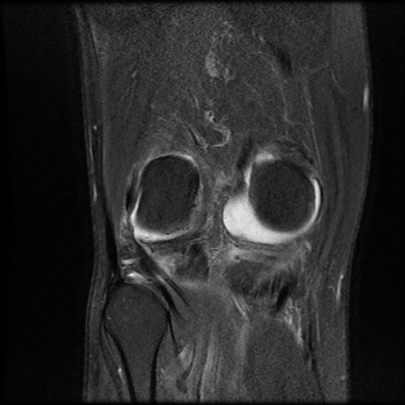 File:Anterior cruciate ligament graft tear and bucket-handle tear of medial meniscus (Radiopaedia 75867-87255 Coronal PD fat sat 20).jpg