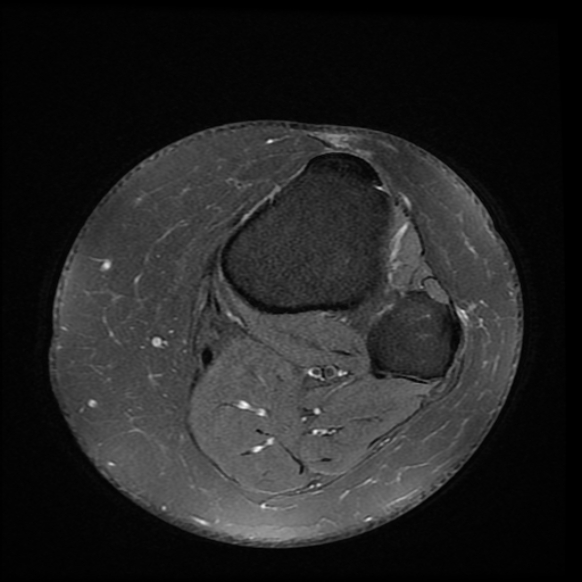 File:Anterior cruciate ligament tear, Wrisberg rip and bucket-handle tear of medial meniscus (Radiopaedia 75872-87266 Axial PD fat sat 1).jpg
