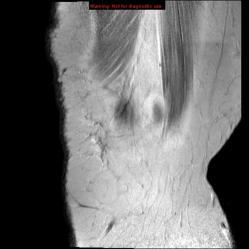 File:Anterior cruciate ligament tear (Radiopaedia 12329-12612 Sagittal T2 fat sat 21).jpg