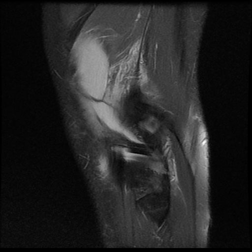 File:Anterior cruciate ligament tear (Radiopaedia 61500-69462 Sagittal PD fat sat 18).jpg