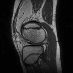 Anterior cruciate ligament tear - pediatric (Radiopaedia 62152-70260 Sagittal PD 133).jpg